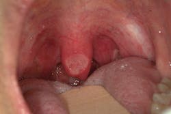 Figure 4: Uvula with an ulcer. Photo courtesy of Dr. A. Ross Kerr. Figure 4: Uvula with an ulcer. Photo courtesy of Dr. A. Ross Kerr.