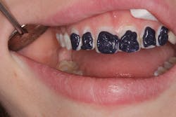 Figure 3: Application of Opalustre Figure 3: Application of Opalustre