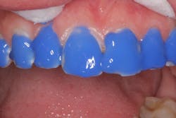 Figure 4: Application of Vococid Figure 4: Application of Vococid