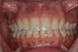 Figure 6: Etching of fractured edge Figure 6: Etching of fractured edge