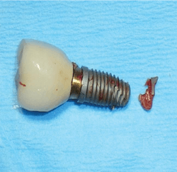 Figure 1: Implant with titanium fracture. Photo courtesy of M. Virginia Kirkland, DMD, MS. Figure 1: Implant with titanium fracture. Photo courtesy of M. Virginia Kirkland, DMD, MS.