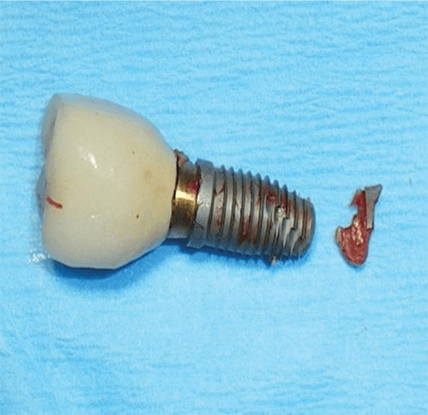 Figure 1: Implant with titanium fracture. Photo courtesy of M. Virginia Kirkland, DMD, MS.