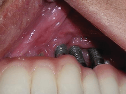 Figure 2: Exposed implant threads under a hybrid denture post present a cleaning challenge. Photo courtesy of Dennis B. Davis, DMD, MS. Figure 2: Exposed implant threads under a hybrid denture post present a cleaning challenge. Photo courtesy of Dennis B. Davis, DMD, MS.