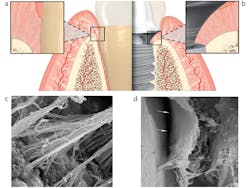 FIGURE 3: A comparison of periodontium and peri-implant soft tissue characteristics. A, Sharpey’s fibers attach to the cementum of natural teeth and are oriented perpendicular to the tooth surface. B, By comparison, peri-implant connective tissue is primarily oriented parallel or circumferentially to the abutment surface. C, A scanning electronic micrograph (SEM) image of the strong attachment between Sharpey’s fibers and cementum in natural teeth. D, An SEM image of the parallel orientation of collagen fibers around a titanium abutment. Illustration courtesy of Nobel Biocare. SEM images © Schüpbach Ltd., Peter Schuepbach (pmschupbach@mac.com). FIGURE 3: A comparison of periodontium and peri-implant soft tissue characteristics. A, Sharpey’s fibers attach to the cementum of natural teeth and are oriented perpendicular to the tooth surface. B, By comparison, peri-implant connective tissue is primarily oriented parallel or circumferentially to the abutment surface. C, A scanning electronic micrograph (SEM) image of the strong attachment between Sharpey’s fibers and cementum in natural teeth. D, An SEM image of the parallel orientation of collagen fibers around a titanium abutment. Illustration courtesy of Nobel Biocare. SEM images © Schüpbach Ltd., Peter Schuepbach (pmschupbach@mac.com).
