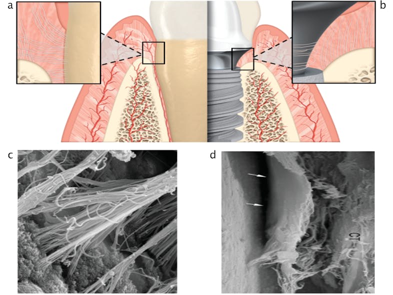 FIGURE 3: A comparison of periodontium and peri-implant soft tissue characteristics. A, Sharpey&rsquo;s fibers attach to the cementum of natural teeth and are oriented perpendicular to the tooth surface. B, By comparison, peri-implant connective tissue is primarily oriented parallel or circumferentially to the abutment surface. C, A scanning electronic micrograph (SEM) image of the strong attachment between Sharpey&rsquo;s fibers and cementum in natural teeth. D, An SEM image of the parallel orientation of collagen fibers around a titanium abutment. Illustration courtesy of Nobel Biocare. SEM images &copy; Schüpbach Ltd., Peter Schuepbach (pmschupbach@mac.com).