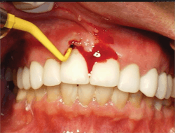 Figure 4: Implant exam with probe reveals signs of peri-implantitis. Photo courtesy of M. Virginia Kirkland, DMD, MS. Figure 4: Implant exam with probe reveals signs of peri-implantitis. Photo courtesy of M. Virginia Kirkland, DMD, MS.