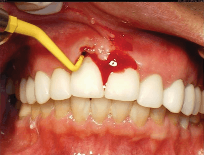 Figure 4: Implant exam with probe reveals signs of peri-implantitis. Photo courtesy of M. Virginia Kirkland, DMD, MS.