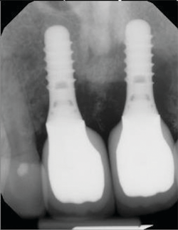 Figure 5: Radiographic bone loss evident. Photo courtesy of M. Virginia Kirkland, DMD, MS.