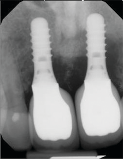Figure 5: Radiographic bone loss evident. Photo courtesy of M. Virginia Kirkland, DMD, MS. Figure 5: Radiographic bone loss evident. Photo courtesy of M. Virginia Kirkland, DMD, MS.
