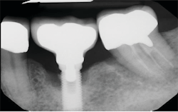 Figure 6: X-ray shows retained cement on mesial of implant. Photo courtesy of M. Virginia Kirkland, DMD, MS. Figure 6: X-ray shows retained cement on mesial of implant. Photo courtesy of M. Virginia Kirkland, DMD, MS.
