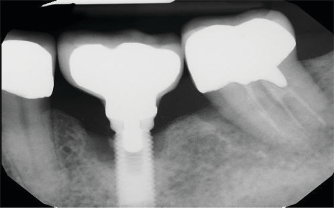 Figure 6: X-ray shows retained cement on mesial of implant. Photo courtesy of M. Virginia Kirkland, DMD, MS.