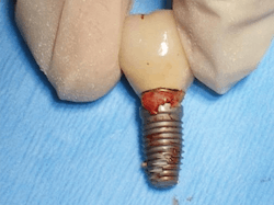 Figure 7: Explant exposing piece of cement. Photo courtesy of M. Virginia Kirkland, DMD, MS. Figure 7: Explant exposing piece of cement. Photo courtesy of M. Virginia Kirkland, DMD, MS.