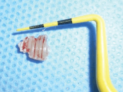 Figure 8: Cement removed from implant. Photo courtesy of M. Virginia Kirkland, DMD, MS. Figure 8: Cement removed from implant. Photo courtesy of M. Virginia Kirkland, DMD, MS.