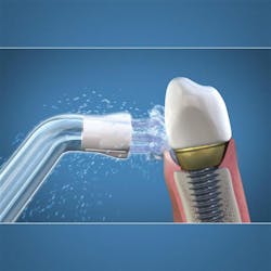 Figure 9: Plaque Seeker brush tip aimed at implant. Illustration courtesy of Water Pik Inc. Figure 9: Plaque Seeker brush tip aimed at implant. Illustration courtesy of Water Pik Inc.
