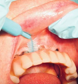 Figure 10: An interdental brush fits easily under a fixed denture. Photo courtesy of Dennis Davis, DMD, MS. Figure 10: An interdental brush fits easily under a fixed denture. Photo courtesy of Dennis Davis, DMD, MS.