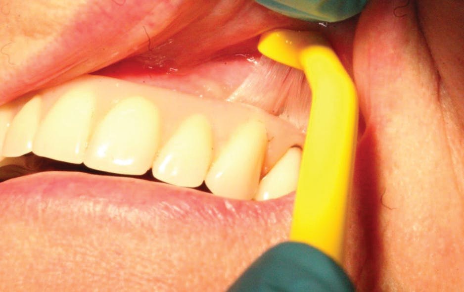 Figure 11: Universal Care brush adapting to fixed denture. Photo courtesy of Dennis Davis, DMS, MS.