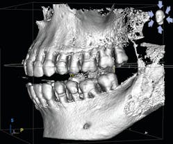 Figure 1: CBCT surface mode image clearly showing bone loss and furcation involvement in a patient with periodontal disease. To explain this image to the patient, I pointed out the location of the cementoenamel junction (CEJ) and let her know that the alveolar bone should be no more than 1 mm to 1.5 mm away from the CEJ in perfect health. I also clearly discussed the fact that the missing bone is gone forever and that we need to prevent any further damage with treatment.
