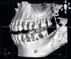 Figure 1: CBCT surface mode image clearly showing bone loss and furcation involvement in a patient with periodontal disease. To explain this image to the patient, I pointed out the location of the cementoenamel junction (CEJ) and let her know that the alveolar bone should be no more than 1 mm to 1.5 mm away from the CEJ in perfect health. I also clearly discussed the fact that the missing bone is gone forever and that we need to prevent any further damage with treatment. Figure 1: CBCT surface mode image clearly showing bone loss and furcation involvement in a patient with periodontal disease. To explain this image to the patient, I pointed out the location of the cementoenamel junction (CEJ) and let her know that the alveolar bone should be no more than 1 mm to 1.5 mm away from the CEJ in perfect health. I also clearly discussed the fact that the missing bone is gone forever and that we need to prevent any further damage with treatment.