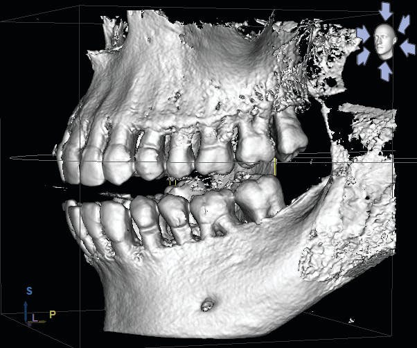 Figure 1: CBCT surface mode image clearly showing bone loss and furcation involvement in a patient with periodontal disease. To explain this image to the patient, I pointed out the location of the cementoenamel junction (CEJ) and let her know that the alveolar bone should be no more than 1 mm to 1.5 mm away from the CEJ in perfect health. I also clearly discussed the fact that the missing bone is gone forever and that we need to prevent any further damage with treatment.
