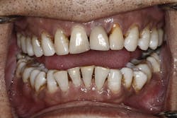 Figure 2: Retracted photo of a patient who uses tobacco products and has periodontal disease. When speaking to this patient, I pointed out the recession, open embrasures, and blunted papillae, which, along with periodontal probing depths of up to 8 mm, are evidence of the damage the infection has caused. We needed to treat with gum infection therapy. I also seized the opportunity to discuss with the patient the effects of tobacco on the periodontium and other oral tissues, as well as the oral-systemic link. Figure 2: Retracted photo of a patient who uses tobacco products and has periodontal disease. When speaking to this patient, I pointed out the recession, open embrasures, and blunted papillae, which, along with periodontal probing depths of up to 8 mm, are evidence of the damage the infection has caused. We needed to treat with gum infection therapy. I also seized the opportunity to discuss with the patient the effects of tobacco on the periodontium and other oral tissues, as well as the oral-systemic link.