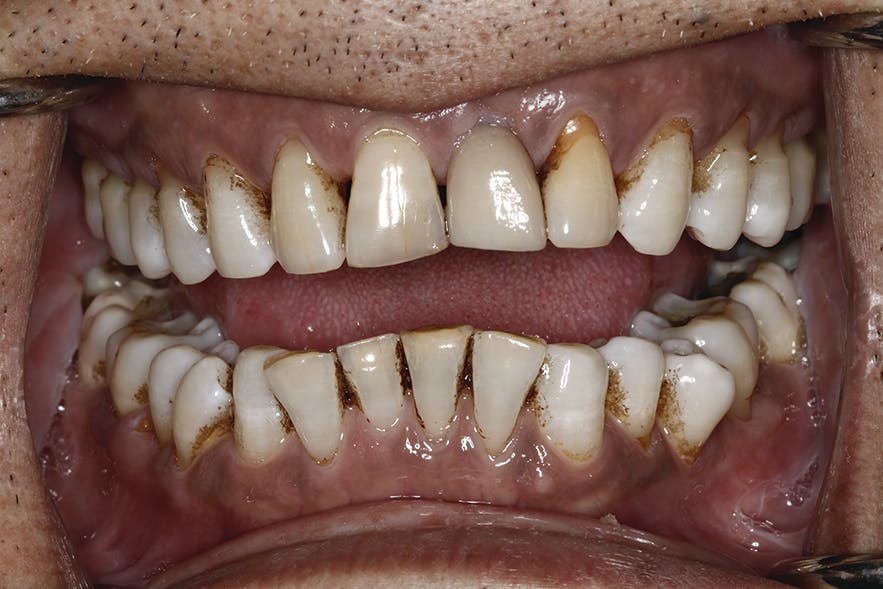 Figure 2: Retracted photo of a patient who uses tobacco products and has periodontal disease. When speaking to this patient, I pointed out the recession, open embrasures, and blunted papillae, which, along with periodontal probing depths of up to 8 mm, are evidence of the damage the infection has caused. We needed to treat with gum infection therapy. I also seized the opportunity to discuss with the patient the effects of tobacco on the periodontium and other oral tissues, as well as the oral-systemic link.
