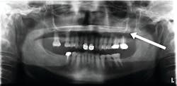 Figure 1: A well-circumscribed, asymptomatic, slightly radiopaque mass within the sinus cavity, illustrating an antral pseudocyst. Image courtesy of Shawn Adibi, DDS, MEd, FAAOM.