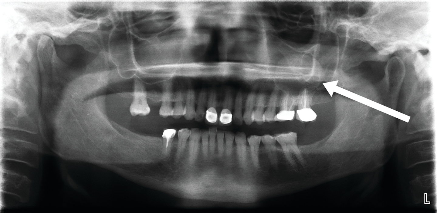 Antral Pseudocysts Registered Dental Hygienist Rdh Magazine