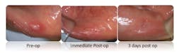 Figure 1: Images reveal aphthous ulcer before, immediately following, and three days post-op laser treatment to help alleviate pain and expedite resolution. Figure 1: Images reveal aphthous ulcer before, immediately following, and three days post-op laser treatment to help alleviate pain and expedite resolution.