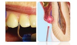Figure 2: Laser tip placed inside periodontal pocket. Image depicts laser tip able to target pigmented bacteria once activated. Figure 2: Laser tip placed inside periodontal pocket. Image depicts laser tip able to target pigmented bacteria once activated.