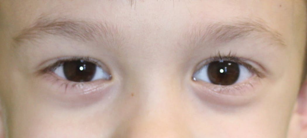 Figure 2: Examples of allergic shiners.