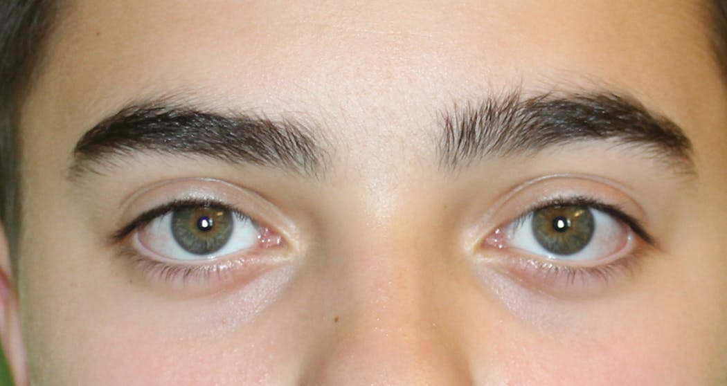 Figure 3: Example of visible sclera