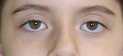 Figure 4: Example of visible sclera Figure 4: Example of visible sclera
