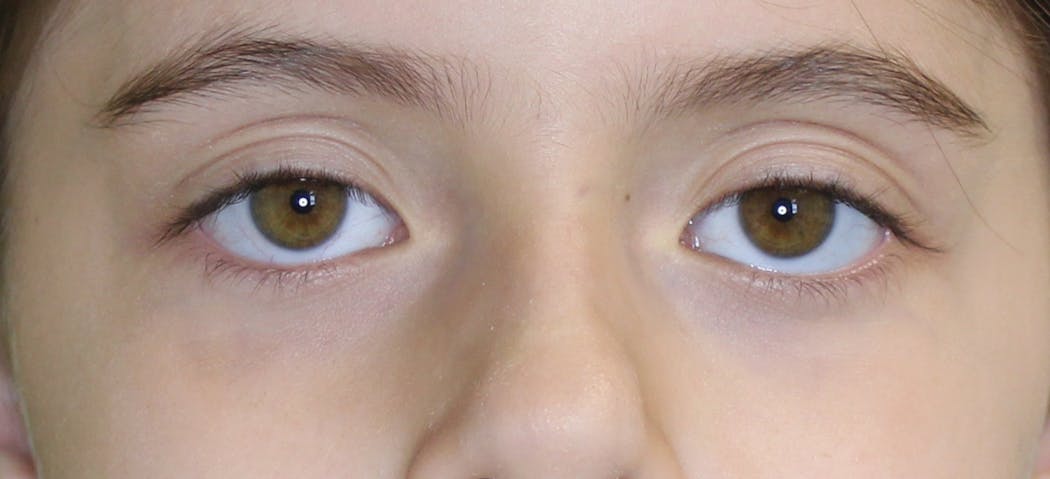 Figure 4: Example of visible sclera
