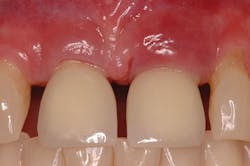 Figure 1: Peri-implant mucositis on upper anterior tooth. Source: American Academy of Periodontology, 2019. Used with permission.
