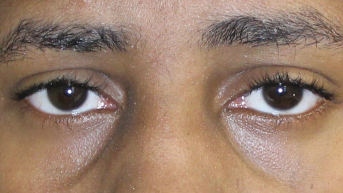 Sunken Eyes: Causes and Treatment