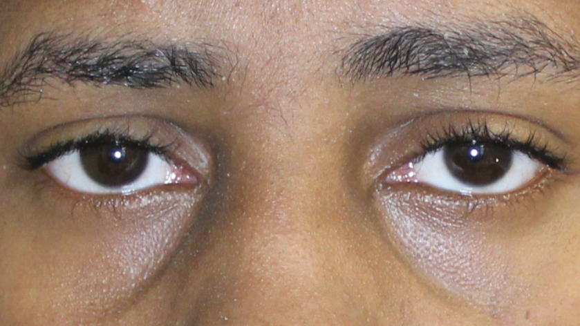 Eye Spy What The Eyes Can Tell Us About The Mouth Registered Dental Hygienist Rdh Magazine Eye Spy What The Eyes Can Tell Us About The Mouth Registered Dental Hygienist Rdh Magazine