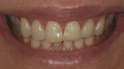 Figure 1: Erosion of enamel with thinning, graying, and chipping of upper incisors. This is typical of extrinsic acid damage and exacerbated by bruxism. Figure 1: Erosion of enamel with thinning, graying, and chipping of upper incisors. This is typical of extrinsic acid damage and exacerbated by bruxism.
