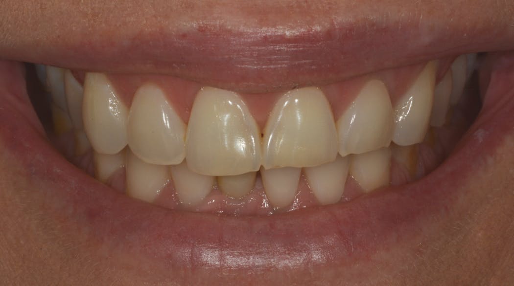 Figure 1: Erosion of enamel with thinning, graying, and chipping of upper incisors. This is typical of extrinsic acid damage and exacerbated by bruxism.