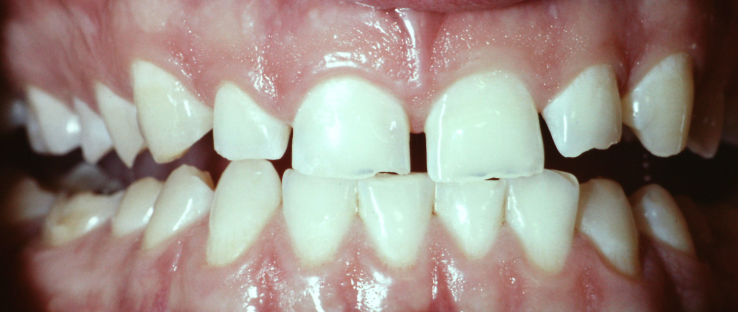 Tooth Erosion Q A A Pop Quiz For Dental Hygienists Registered tooth erosion q a a pop quiz for