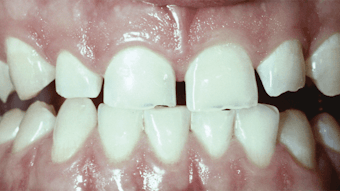 Thyroid Issues Goiters And Other Conditions Pinpoint The Thyroid Gland S Effect On The Body Registered Dental Hygienist Rdh Magazine