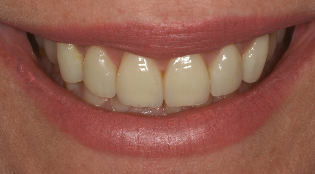 Figure 4: This is the same patient that was featured in Question 1. Following dietary advice and counseling, the teeth were restored with veneers to improve length, and the patient was provided with a Michigan splint night guard.