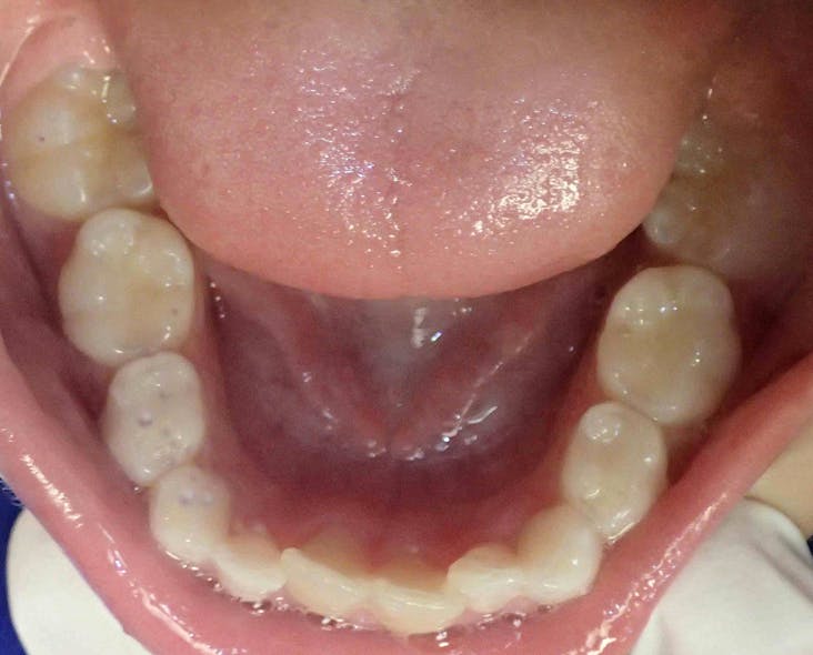 Figure 1: Pitted molars due to sleep bruxism and possible GERD damage. Teeth have a whitewashed appearance as well. Photo courtesy of Carol Jin, DDS, San Ramon, California. Used with permission.