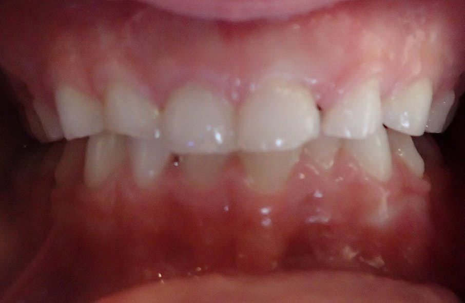 Figure 2: Evidence of incisal-edge damage due to sleep bruxism. Wear from grinding occurs on mandibular teeth first, followed by maxillary teeth. Photo courtesy of Carol Jin, DDS, San Ramon, California. Used with permission.