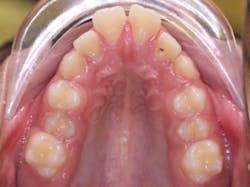 Figure 3: Narrow palate can be an indication of mouth breathing and vertical and facial jaw development as depicted in this image. Photo courtesy of Will Schlicher, DMD, MS, Pleasanton, California. Used with permission. Figure 3: Narrow palate can be an indication of mouth breathing and vertical and facial jaw development as depicted in this image. Photo courtesy of Will Schlicher, DMD, MS, Pleasanton, California. Used with permission.
