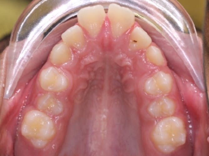 Figure 3: Narrow palate can be an indication of mouth breathing and vertical and facial jaw development as depicted in this image. Photo courtesy of Will Schlicher, DMD, MS, Pleasanton, California. Used with permission.