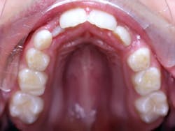 Figure 4: During exfoliation, a child will grind his or her primary teeth, indicating occlusal cupping in an attempt to maintain a flat and level occlusal plane. Photo courtesy of Carol Perkins, BA, AS, RDH. Used with permission. Figure 4: During exfoliation, a child will grind his or her primary teeth, indicating occlusal cupping in an attempt to maintain a flat and level occlusal plane. Photo courtesy of Carol Perkins, BA, AS, RDH. Used with permission.