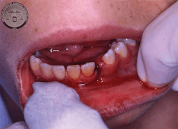 Figure 1: A broken jaw as seen on a child abuse victim. Figure 1: A broken jaw as seen on a child abuse victim.