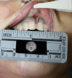 Figure 2: A torn frenum as seen on a child abuse victim. Figure 2: A torn frenum as seen on a child abuse victim.