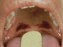 Figure 3: Ecchymosis of the soft palate indicative of oral sexual abuse. Figure 3: Ecchymosis of the soft palate indicative of oral sexual abuse.