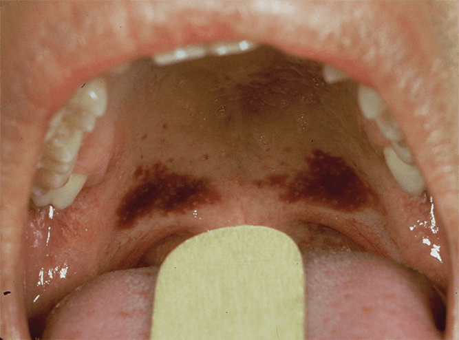 Figure 3: Ecchymosis of the soft palate indicative of oral sexual abuse.